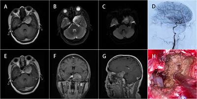 Endoscopic endonasal resection of an epidermoid cyst in the cavernous sinus: A case report and literature review